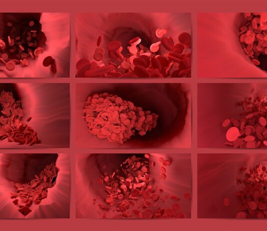 Trombocitopenia trombotica immunitaria indotta da vaccino Pfizer? Nuovo studio pubblicato il 5 agosto 2022